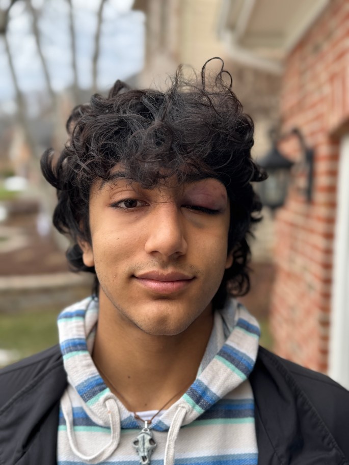 Dec 20, 2025: Yash's first black eye...a freak wrestling accident
